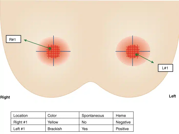 about breast cancer