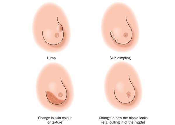 treatment of breast cancer