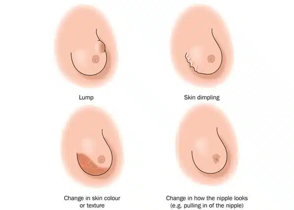 treatment of breast cancer