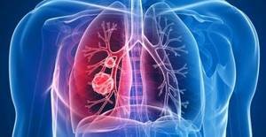 what is mesothelioma