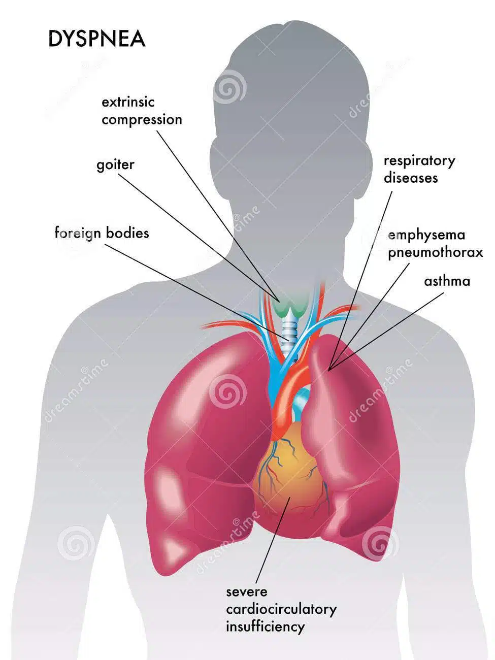 mesothelioma doctors