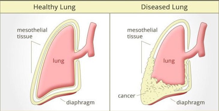mesothelioma facts