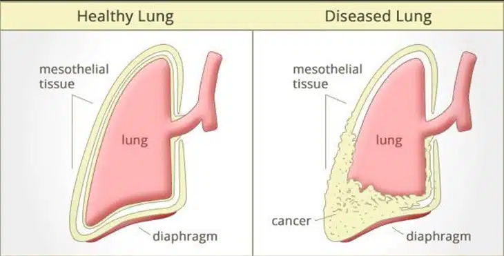 Risk Factors of Mesothelioma