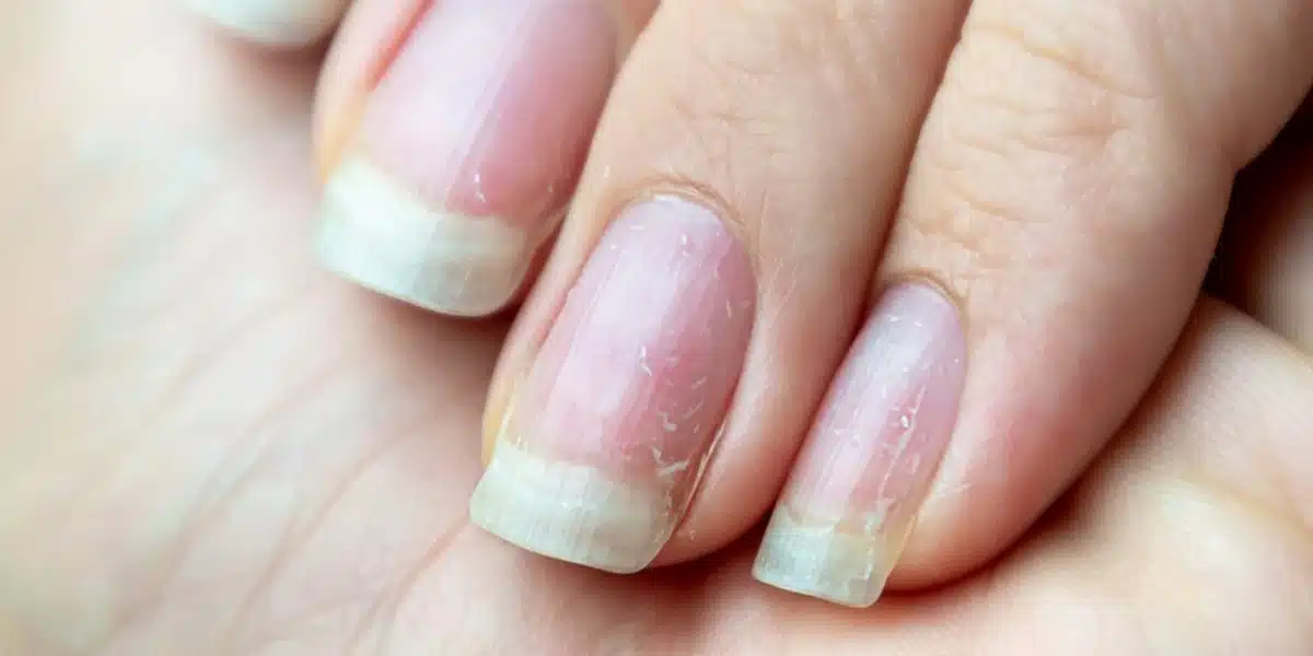 fingernails and health